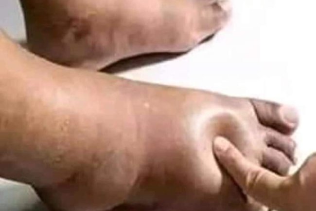 REMEDIES FOR SWOLLEN FEET