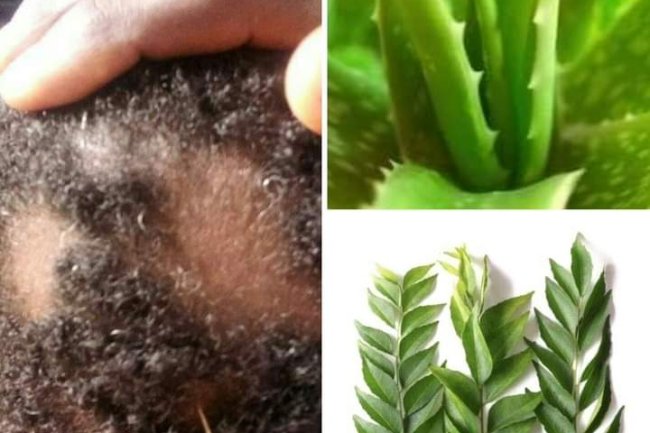 ALOPECIA AREATA AND SOLUTION