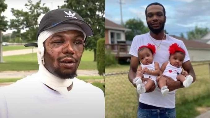 FATHER WHO RAN INTO BURNING HOUSE TO SAVE BABY TWINS GETS BURNED BEYOND RECOGNITION 