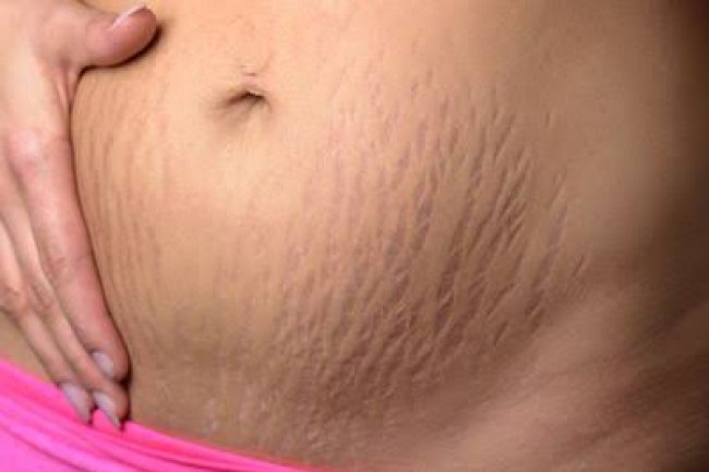 REMEDY FOR STRETCH MARK