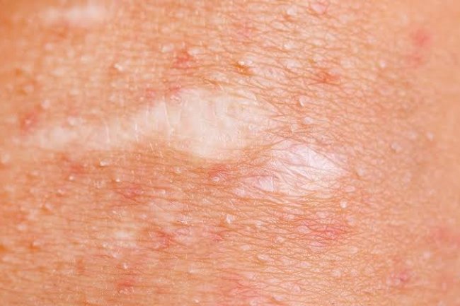 CURE FOR ALL SKIN PROBLEMS