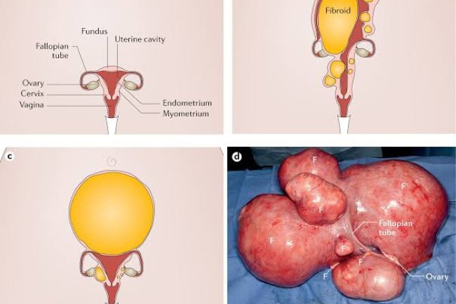 FIBROIDS