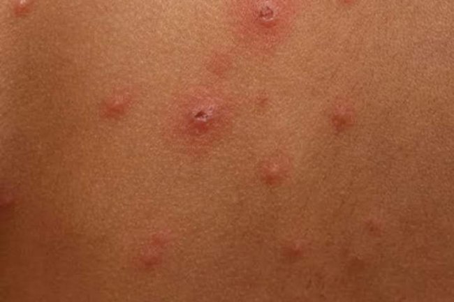 REMEDY FOR CHICKENPOX