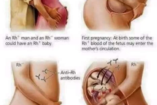 RHESUS FACTOR INCOMPATIBILITY A LEADING CAUSE OF MISCARRIAGE!
