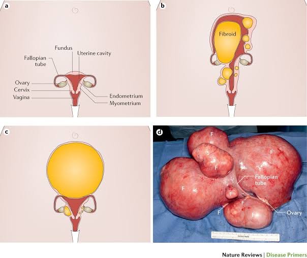 FIBROIDS