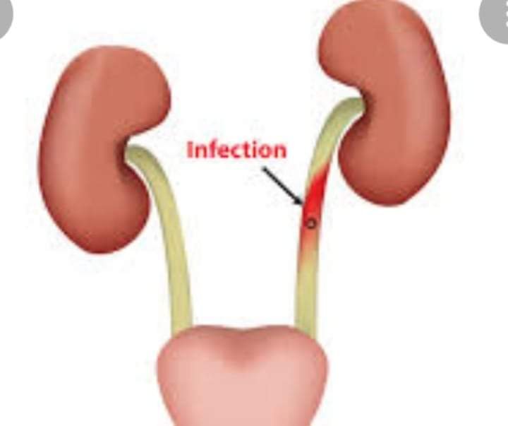 URINARY TRACT INFECTION