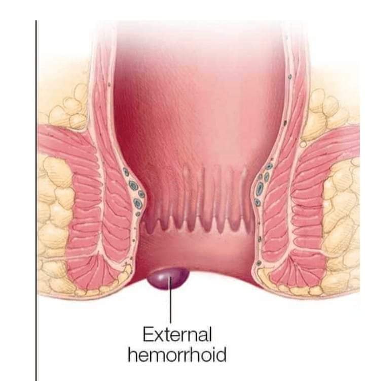 HEMORRHOIDS REMEDY