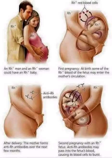 RHESUS FACTOR INCOMPATIBILITY A LEADING CAUSE OF MISCARRIAGE!