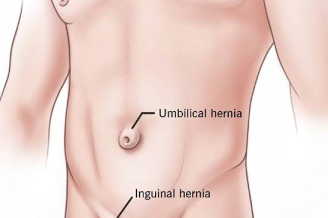 HERBAL REMEDY FOR HERNIA
