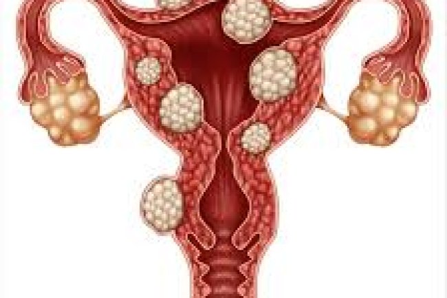 FIBROID REMEDY