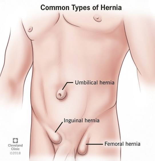 HERBAL REMEDY FOR HERNIA