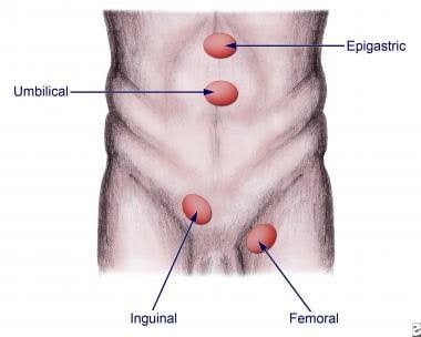 HERBAL REMEDY FOR HERNIA