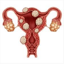 FIBROID REMEDY