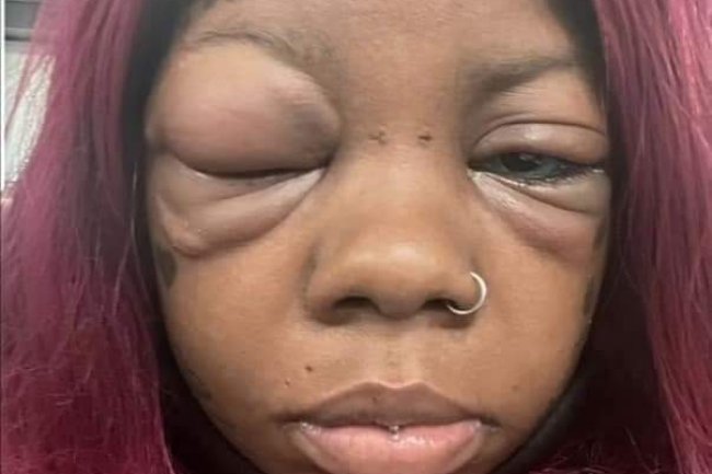 PHOTOS: MOTHER GOING BLIND AFTER TATTOOING HER EYEBALLS BLUE AND PURPLE TO COPY AN INFLUENCER