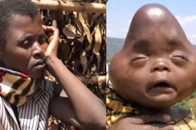 MEET LITTLE BOY WHO HAS AN ALIEN SHAPE OF HEAD