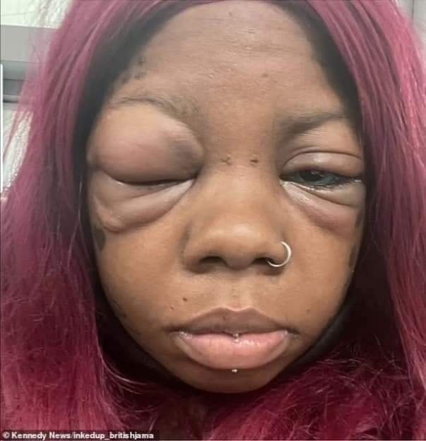 PHOTOS: MOTHER GOING BLIND AFTER TATTOOING HER EYEBALLS BLUE AND PURPLE TO COPY AN INFLUENCER