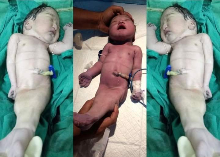 23-YEAR-OLD WOMAN GIVES BIRTH TO REAL LIFE ‘MERMAID’ BABY