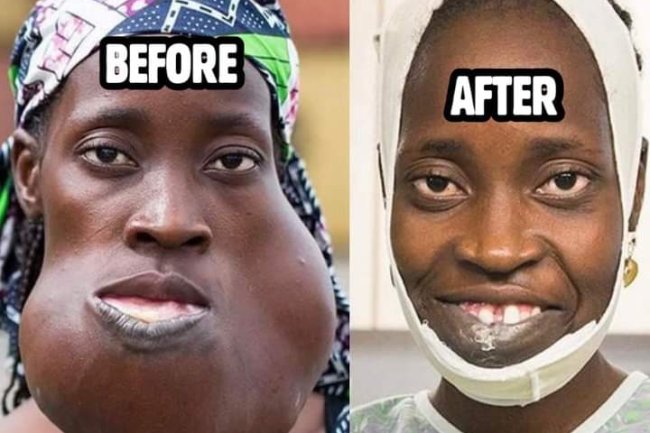 SEE PHOTOS OF NIGERIAN WOMAN WHO CAN FINALLY SMILE AFTER UNDERGOING SURGERY TO REMOVE HUGE FACIAL TUMOUR