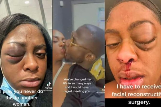 WOMAN WHO HAILED HER BOYFRIEND AS THE BEST IN THE WORLD & FLAUNTED HIS LOVE FOR HER, SHOWS INJURY HE INFLICTED ON HER