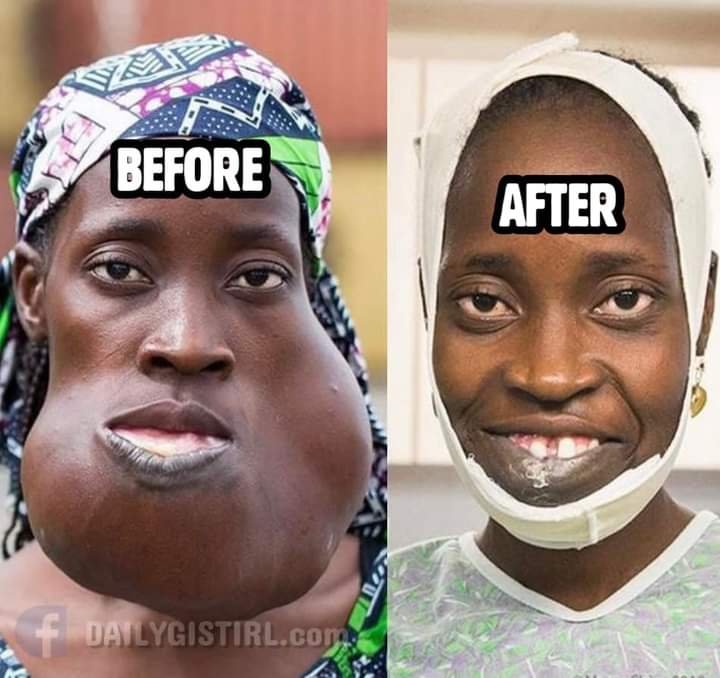 SEE PHOTOS OF NIGERIAN WOMAN WHO CAN FINALLY SMILE AFTER UNDERGOING SURGERY TO REMOVE HUGE FACIAL TUMOUR