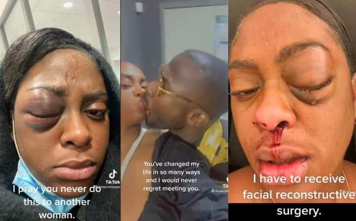 WOMAN WHO HAILED HER BOYFRIEND AS THE BEST IN THE WORLD & FLAUNTED HIS LOVE FOR HER, SHOWS INJURY HE INFLICTED ON HER