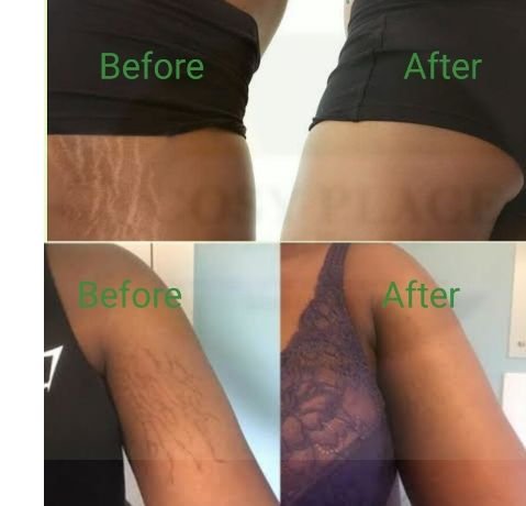 EASY WAY TO REMOVE STRETCH MARK FROM YOUR SKIN