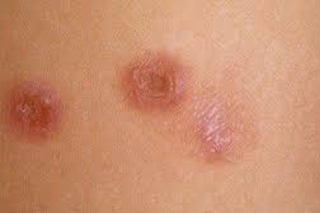 How to get rid of skin sores