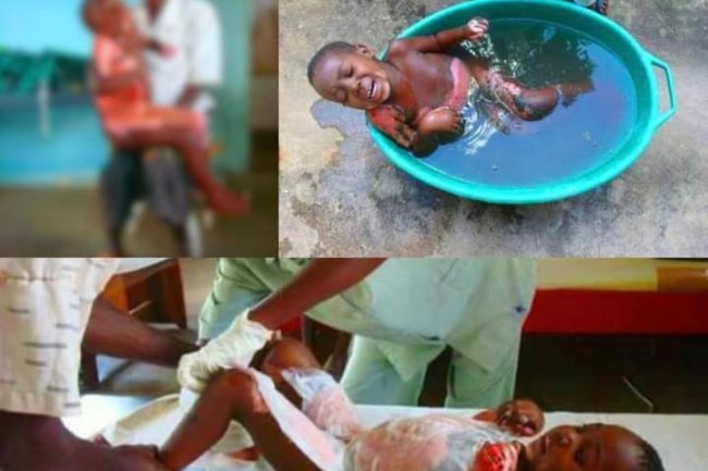 SAD AS WICKED STEP-MOTHER POURS HOT WATER ON HER YOUNG STEPDAUGHTER IN LAGOS
