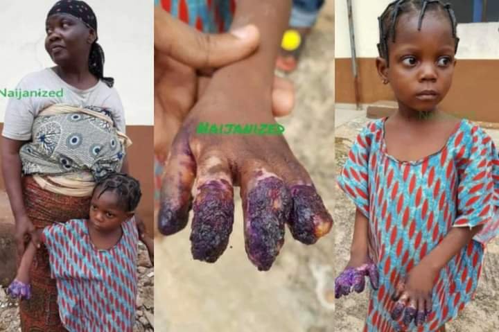 GRANDMOTHER BURNS GRANDDAUGHTER’S HANDS BECAUSE SHE ATE INDOMIE WITHOUT HER PERMISSION