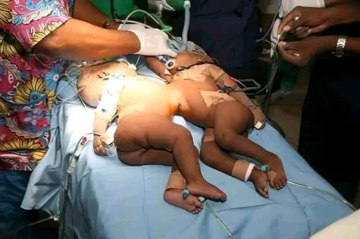 MEET PROF. AUWAL M. ABUBAKAR, THE MEDICAL DIRECTOR OF FMC YOLA THAT SEPARATED SEVERAL CONJOINED TWINS