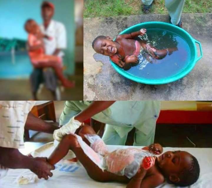 SAD AS WICKED STEP-MOTHER POURS HOT WATER ON HER YOUNG STEPDAUGHTER IN LAGOS