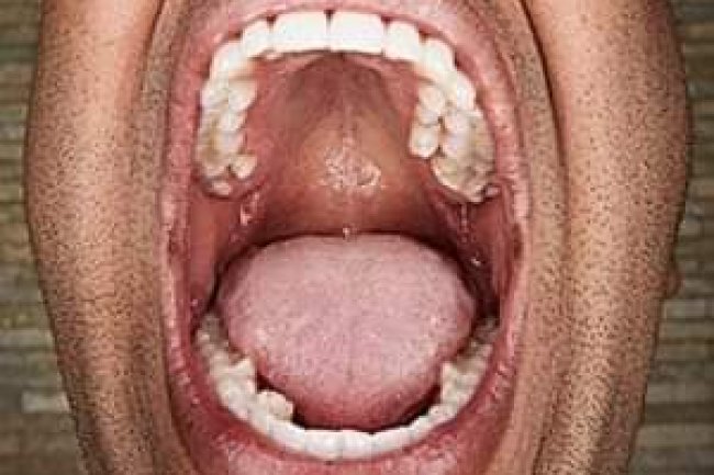A LITTLE MUCH AND TOO MUCH TEETH: MEET THE MAN AND THE TEENAGER WITH THE MOST TEETH 