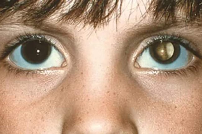 RETINOBLASTOMA, THE COMMON FORM OF EYE CANCER IN CHILDREN