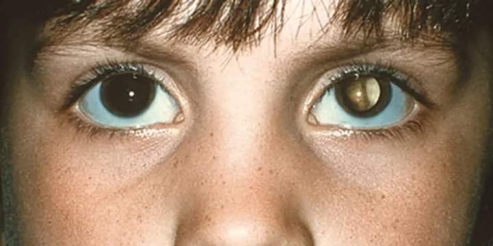 RETINOBLASTOMA, THE COMMON FORM OF EYE CANCER IN CHILDREN